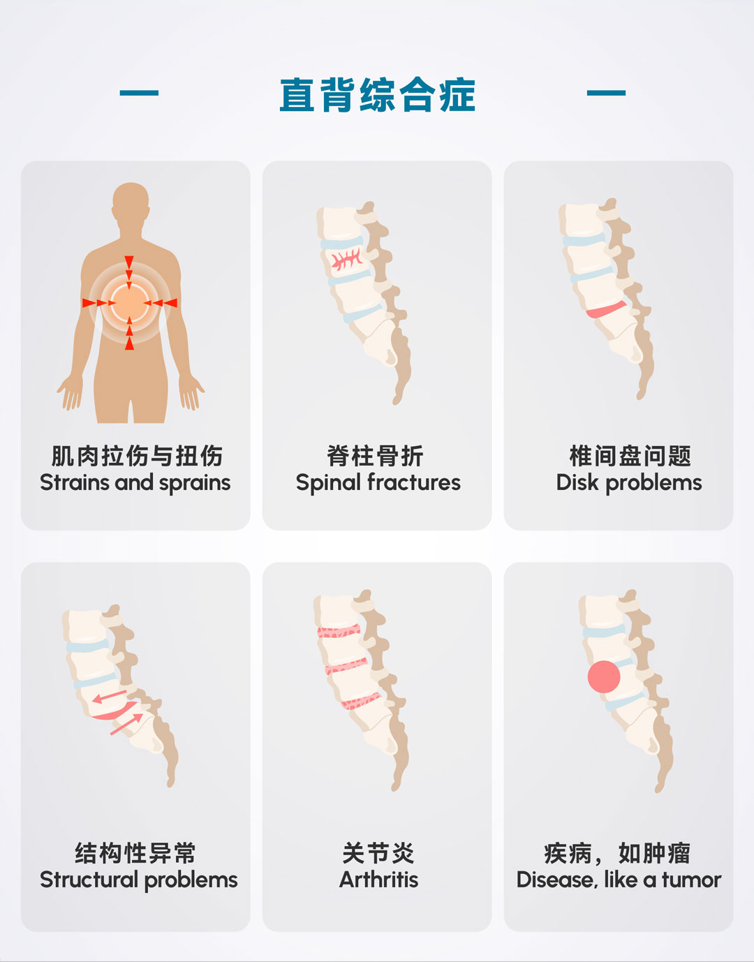 直背综合征.jpg