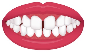 Spaced Teeth Spaced Teeth