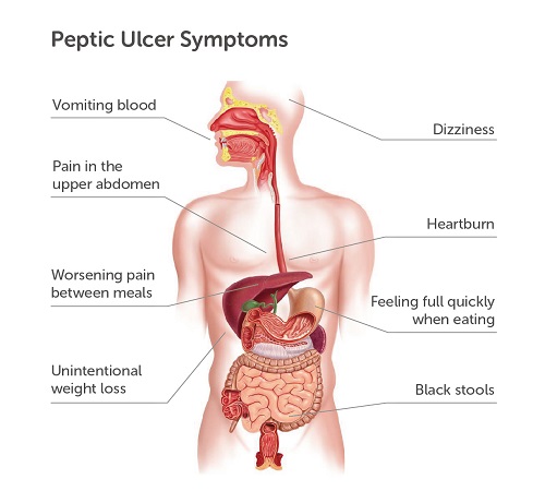 Peptic Ulcer Symptoms Peptic Ulcer Symptoms